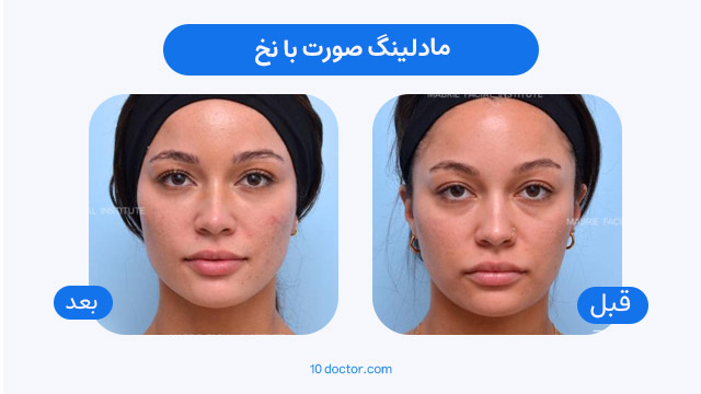مادلینگ صورت با نخ
