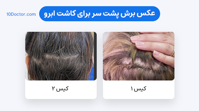 عکس برش پشت سر برای کاشت ابرو