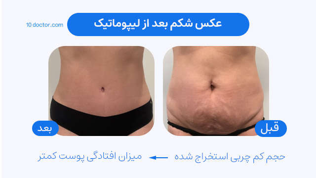 عکس شکم بعد از لیپوماتیک