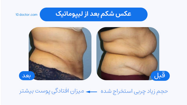 عکس شکم بعد از لیپوماتیک