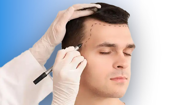 کاشت مو شقیقه