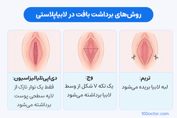 روشهای برداشت بافت در لابیاپلاستی