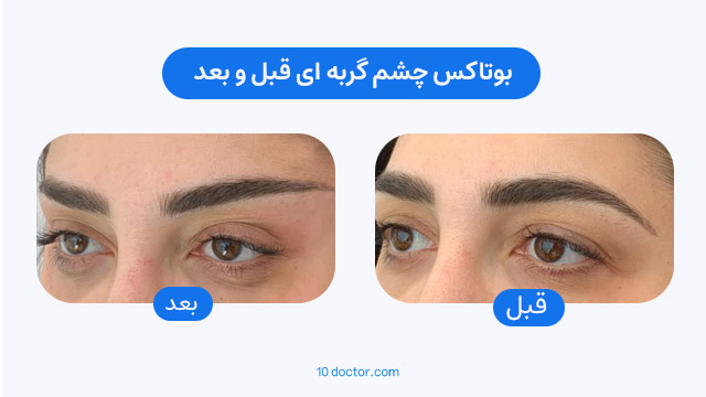 عکس قبل و بعد بوتاکس چشم گربه ای