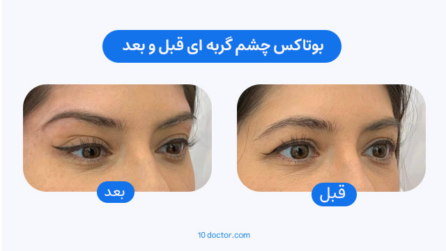عکس قبل و بعد بوتاکس چشم گربه ای