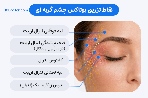 نقاط تزریق بوتاکس چشم گربه ای
