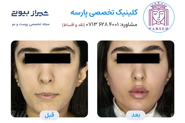 مادلینگ صورت در شیراز - کلینیک پارسه