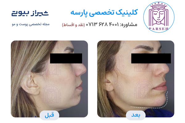 مادلینگ صورت در شیراز - کلینیک پارسه