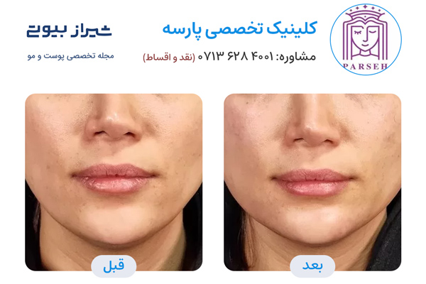 مادلینگ صورت در شیراز - کلینیک پارسه