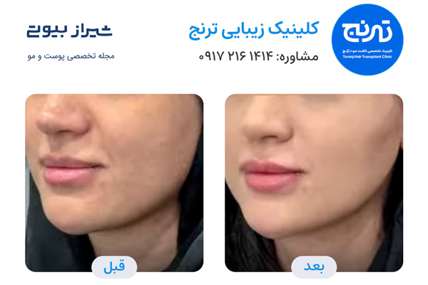 مادلینگ صورت در شیراز - کلینیک ترنج