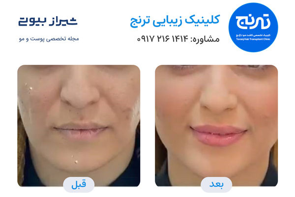 مادلینگ صورت در شیراز - کلینیک ترنج