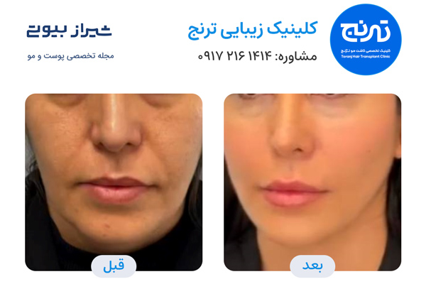 مادلینگ صورت در شیراز - کلینیک ترنج