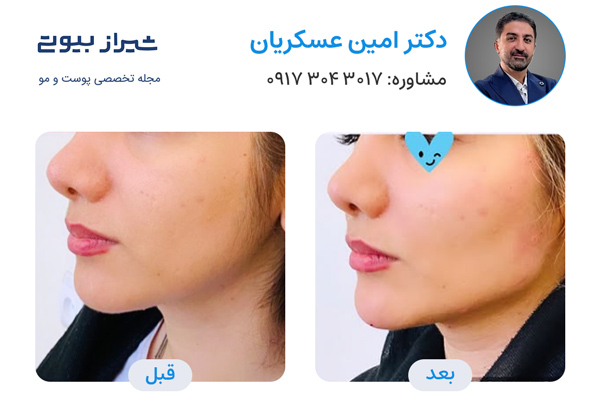 مادلینگ صورت در شیراز - دکتر امین عسکریان