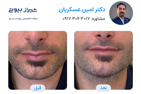 مادلینگ صورت در شیراز - دکتر امین عسکریان