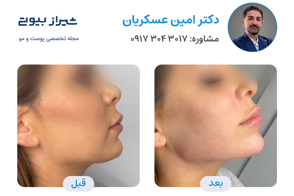 مادلینگ صورت در شیراز - دکتر امین عسکریان