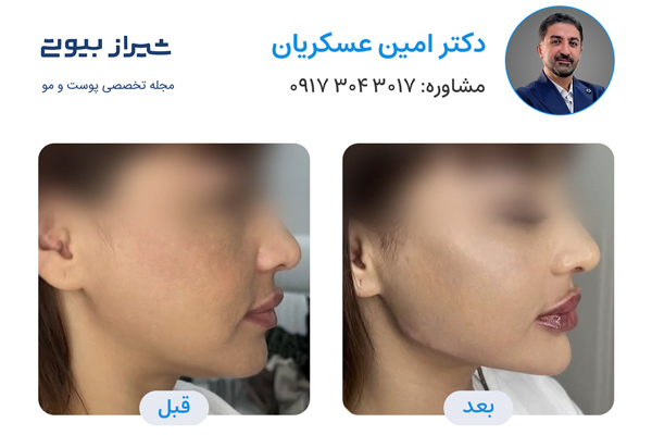 مادلینگ صورت در شیراز - دکتر امین عسکریان