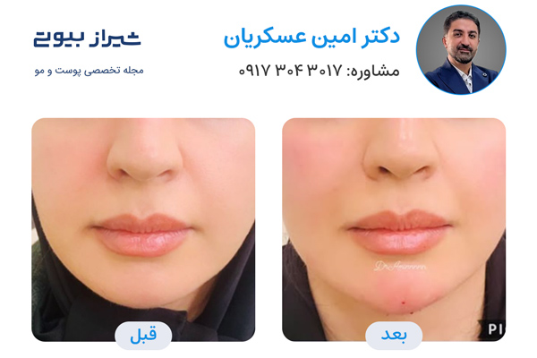 مادلینگ صورت در شیراز - دکتر امین عسکریان