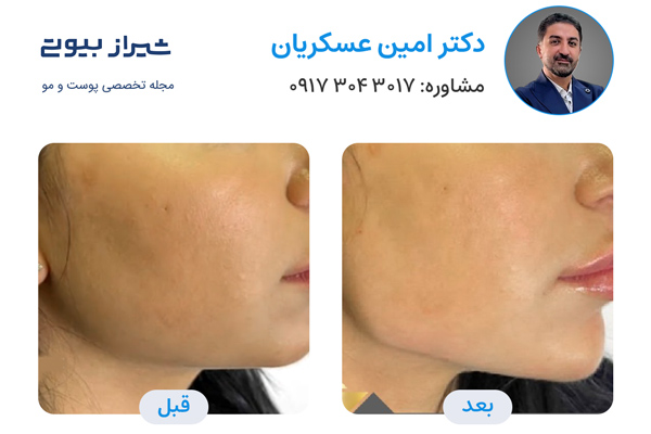 مادلینگ صورت در شیراز - دکتر امین عسکریان
