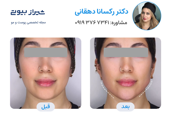 مادلینگ صورت در شیراز - دکتر رکسانا دهقانی