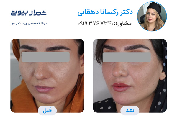 مادلینگ صورت در شیراز - دکتر رکسانا دهقانی