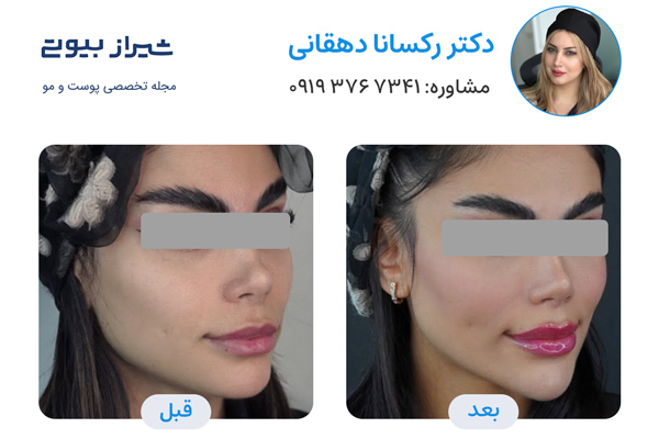 مادلینگ صورت در شیراز - دکتر رکسانا دهقانی