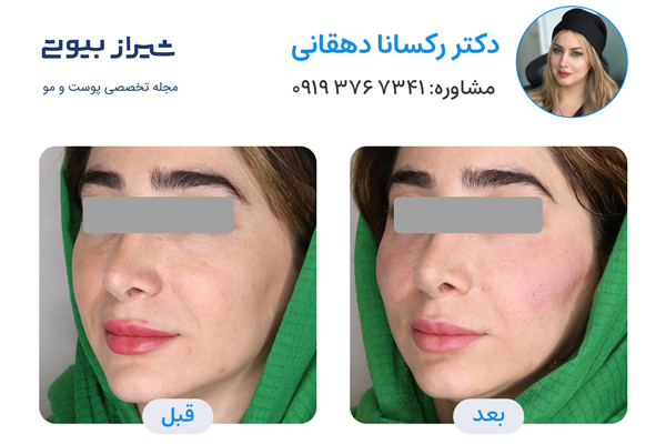 مادلینگ صورت در شیراز - دکتر رکسانا دهقانی