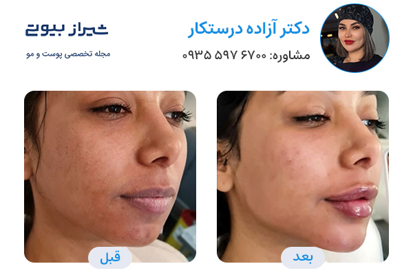 مادلینگ صورت در شیراز - دکتر آزاده درستکار