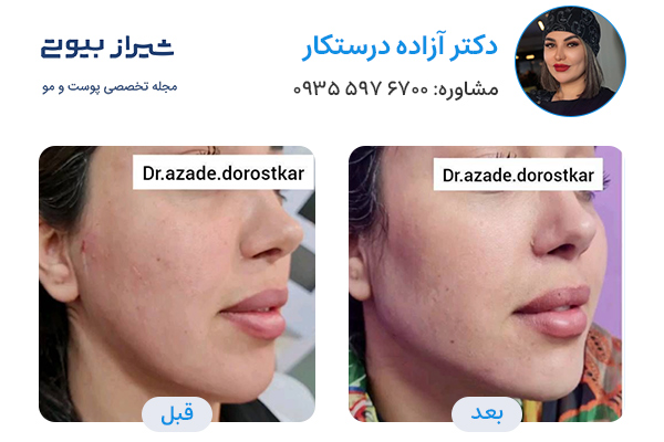 مادلینگ صورت در شیراز - دکتر آزاده درستکار