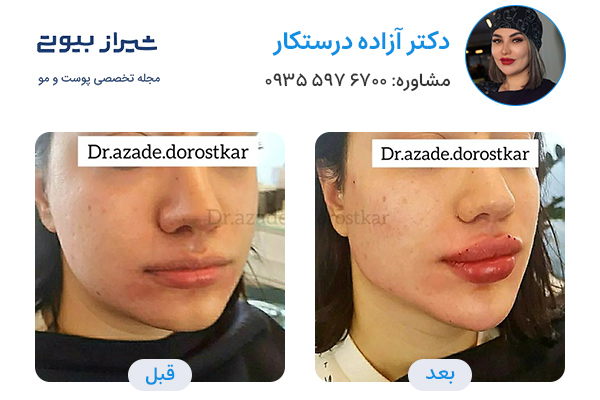 مادلینگ صورت در شیراز - دکتر آزاده درستکار