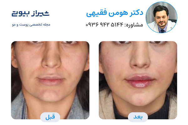 مادلینگ صورت در شیراز - دکتر هومن فقیهی