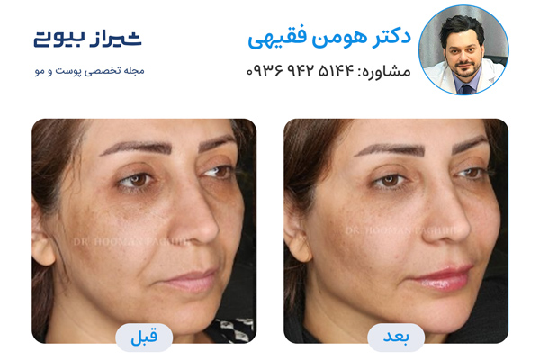 مادلینگ صورت در شیراز - دکتر هومن فقیهی