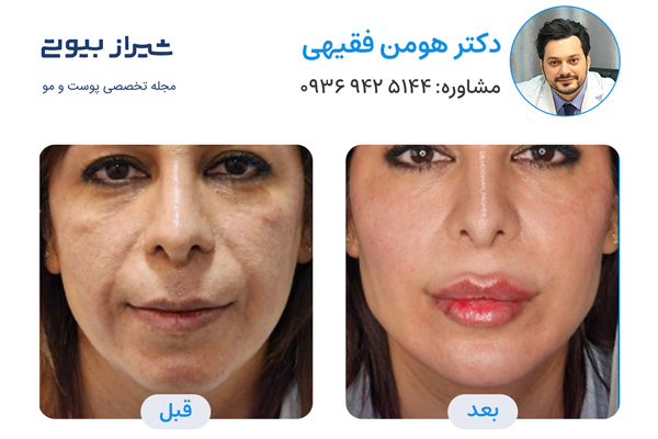 مادلینگ صورت در شیراز - دکتر هومن فقیهی