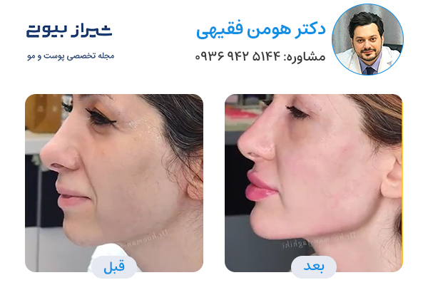 مادلینگ صورت در شیراز - دکتر هومن فقیهی