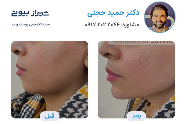 مادلینگ صورت در شیراز - دکتر حمید حجتی