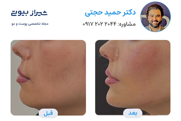 مادلینگ صورت در شیراز - دکتر حمید حجتی