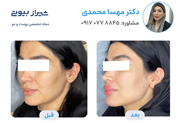 مادلینگ صورت در شیراز - دکتر مهسا محمدی
