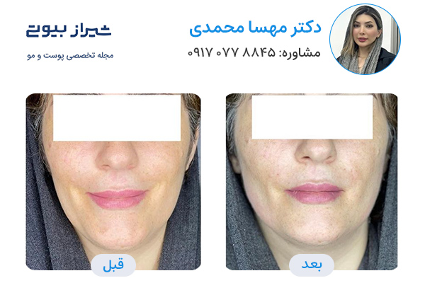 مادلینگ صورت در شیراز - دکتر مهسا محمدی
