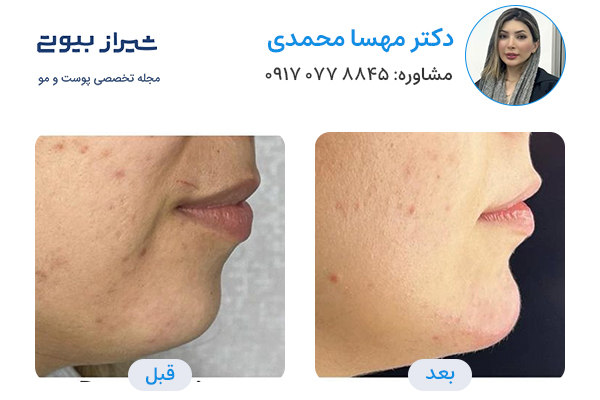 مادلینگ صورت در شیراز - دکتر مهسا محمدی