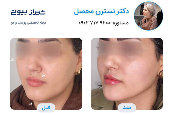 مادلینگ صورت در شیراز - دکتر نسترن محصل