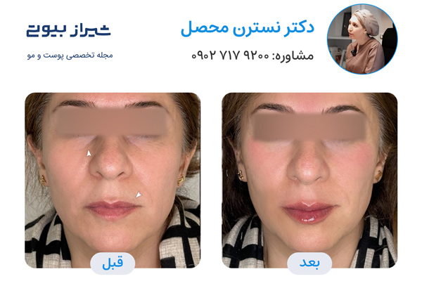 مادلینگ صورت در شیراز - دکتر نسترن محصل