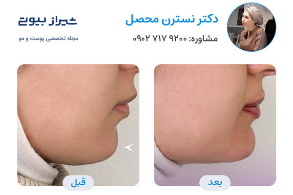 مادلینگ صورت در شیراز - دکتر نسترن محصل