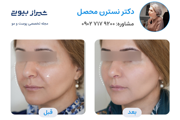 مادلینگ صورت در شیراز - دکتر نسترن محصل