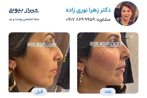 مادلینگ صورت در شیراز - دکتر زهرا نوری زاده