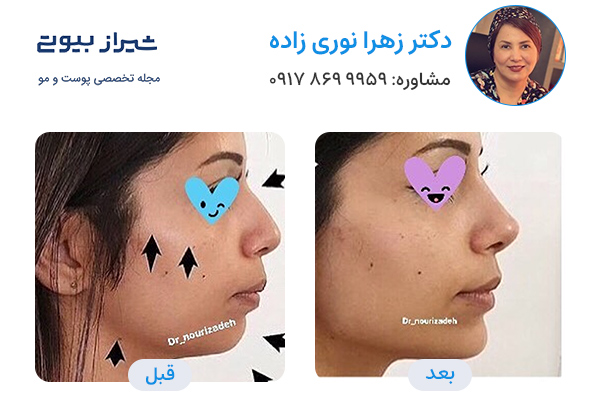 مادلینگ صورت در شیراز - دکتر زهرا نوری زاده