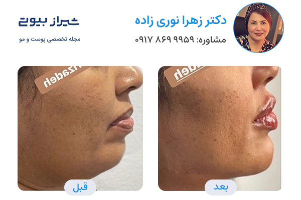 مادلینگ صورت در شیراز - دکتر زهرا نوری زاده