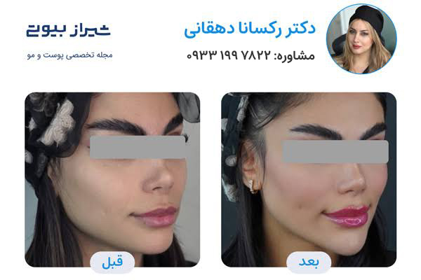 مادلینگ صورت در شیراز - دکتر رکسانا دهقانی
