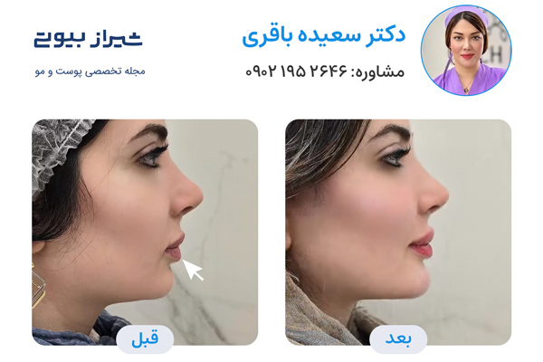مادلینگ صورت در شیراز - دکتر سعیده باقری