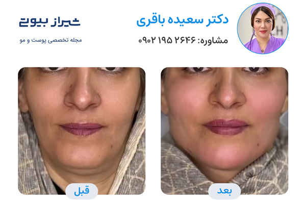 مادلینگ صورت در شیراز - دکتر سعیده باقری
