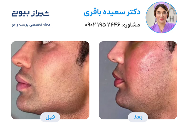 مادلینگ صورت در شیراز - دکتر سعیده باقری