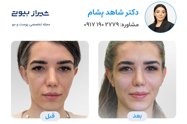 مادلینگ صورت در شیراز - دکتر شاهد پشام