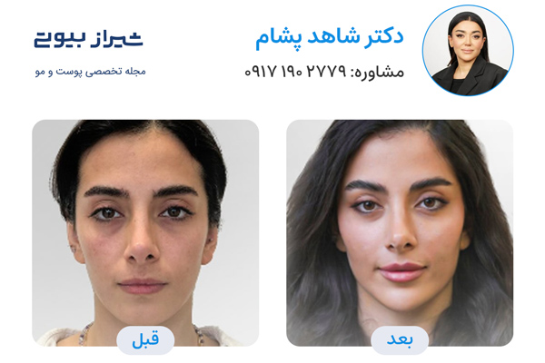 مادلینگ صورت در شیراز - دکتر شاهد پشام